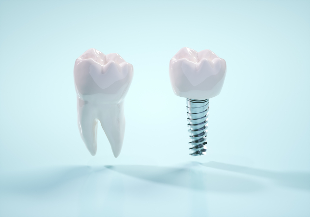 健康な歯とインプラントの比較
